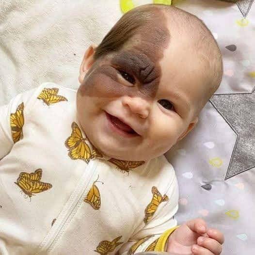 Parents Love Drives Them to Remove Daughters Birthmark… See more